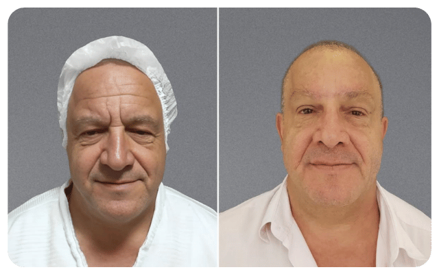 Blefaroplastia + Frontoplastia