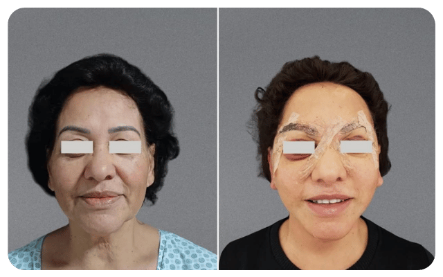 Pré e Pós: Lifting Facial e Deep Neck