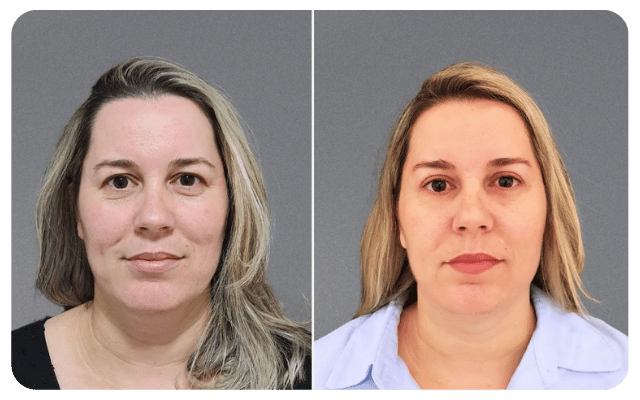 Blefaroplastia Completa