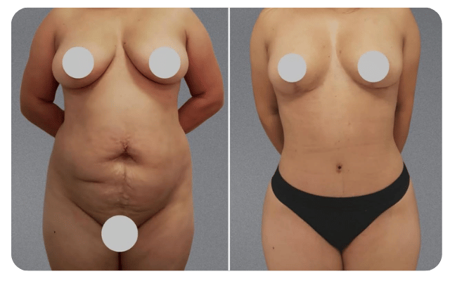 Mamoplastia sem próteses + Lipoaspiração + Abdominoplastia + Gluteoplastia