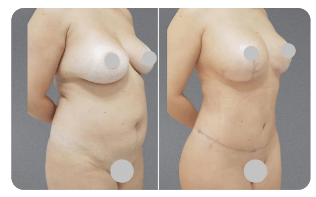 Mastopexia com Prótese + Lipoaspiração + Abdominoplastia + Gluteoplastia