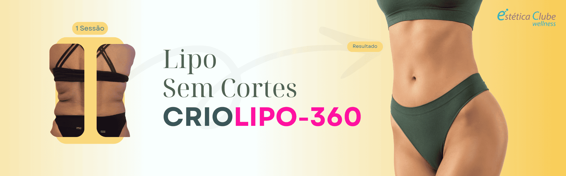 Criolipólise com desconto